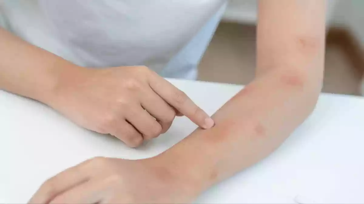 6 Skin Infections That Spike During Monsoon