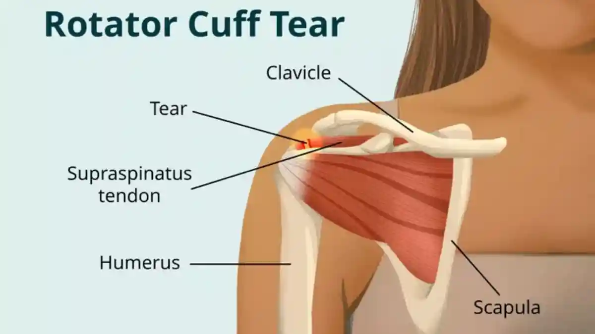 Are We Overlooking Simple Shoulder Injuries That Could Lead To Bigger Problems
