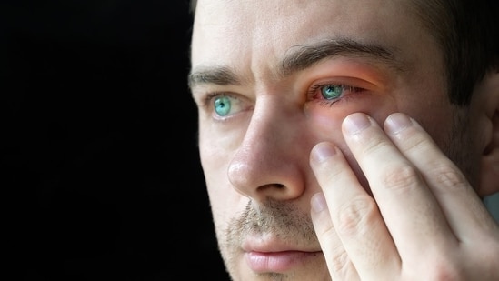 Conjunctivitis, also known as pink eye, is common during the monsoon. Monsoon's weather conditions trigger pink eye often. Dr Mandeep Singh Basu, Director at Jagat Pharma, told HT Lifestyle that conjunctivitis cases see a sharp spike in the monsoon season.