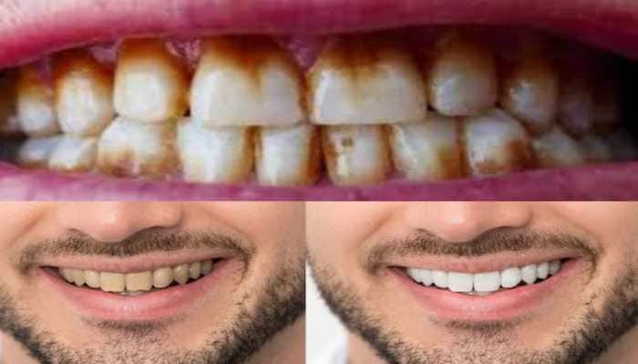 Daily neglect of brushing, smoking, chewing gutkha or paan masala and other habits can make teeth yellow and foul-smelling. These simple remedies are safe, effective and easy to follow. <strong>New Delhi:</strong> A bright, white smile enhances personality and confidence. Natural teeth start off clean and white, but age, lifestyle and certain habits cause them to turn yellow, brown or sometimes even black. Smoking, chewing gutkha or paan masala and irregular brushing contribute to discolouration and bad breath. If untreated, the yellow layer can lead to serious dental and gum problems.