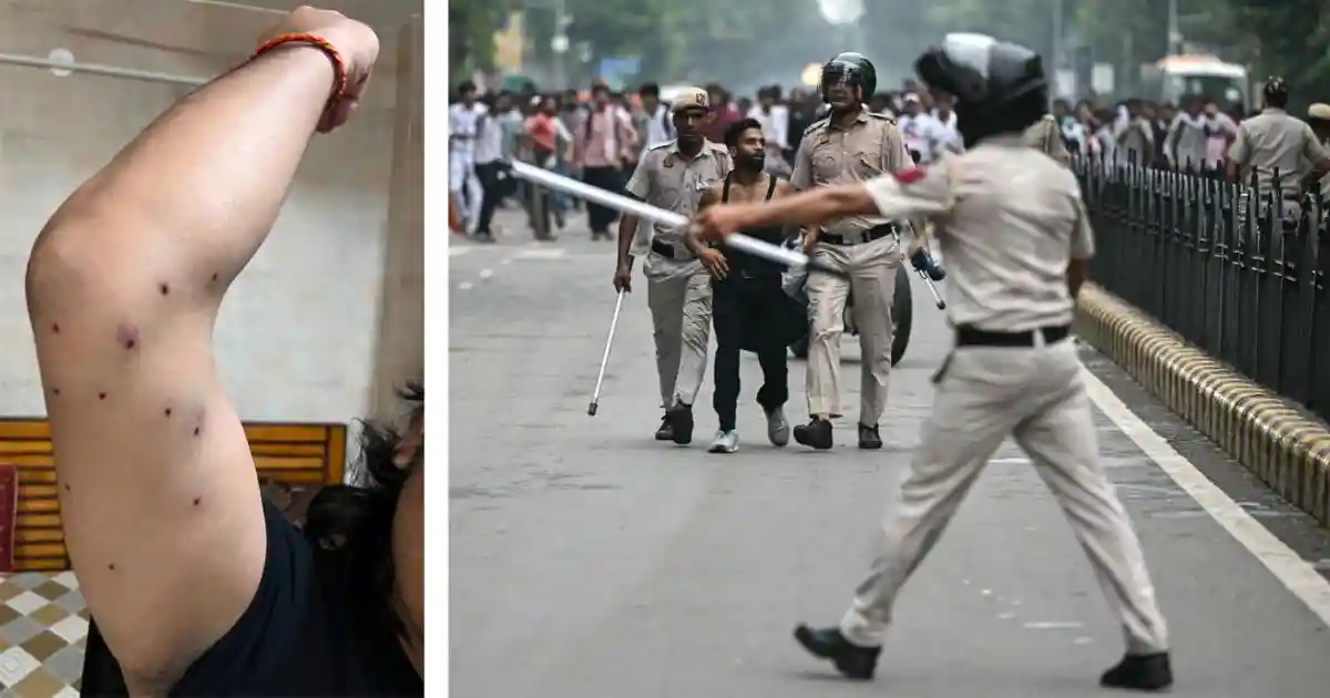 Delhi hospital reports show pellet wounds on journalist covering students’ protests