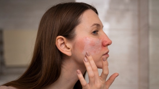 Dr Aanchal Panth, a dermatologist and hair transplant surgeon, took to Instagram on August 13 to highlight the dangers of fairness creams. In the video she posted, Dr Panth discussed the detrimental effects of using steroid creams for skin lightening. She explained that initially, these creams may appear to lighten the skin, but prolonged use leads to thinning skin, visible veins, redness, itching, burning, and increased facial hair. <strong>Also read | </strong><strong>Do fairness creams really work?</strong>