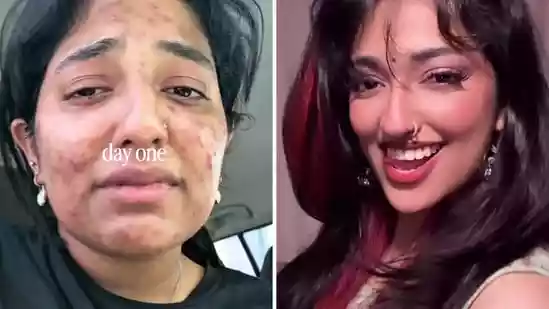 Dubai woman’s acne transformation leaves internet stunned