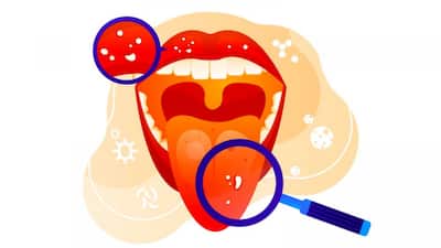 Gone are the days when tobacco was the only cause of tongue cancer. Nowadays millennials (people born between 1981 and 1996) and Gen Z (people born between 1997 and 2012) are developing oral cancer due to sedentary lifestyles, regular consumption of alcohol, and poor oral hygiene.