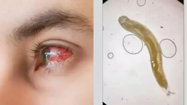 In a rare and alarming medical case from rural India, a 35-year-old man visited an ophthalmologist due to blurry vision, only to discover a live parasitic worm moving inside his eye. The unusual case, recently reported in the New England Journal of Medicine, involved Gnathostoma spinigerum, a parasitic roundworm typically found in cats and dogs. This nematode is known to cause severe eye issues, including vision loss.
