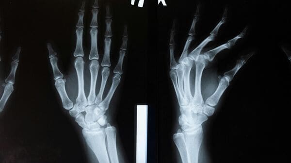 In what could be a breakthrough for orthopaedic treatment, researchers in China have developed a medical adhesive that can repair fractures and shattered bones in as little as three minutes. The adhesive, named “Bone-02”, was unveiled by a research team in Zhejiang Province on September 10, according to a report by Global Times.