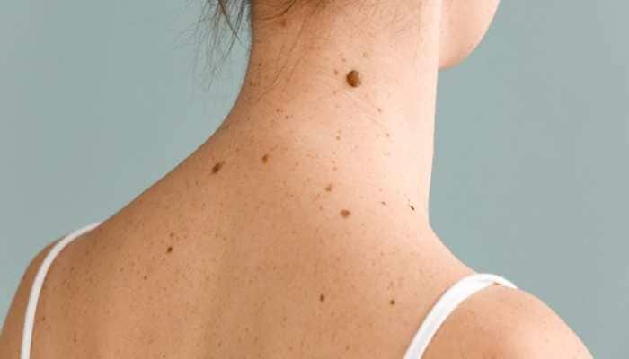 Moles and spots on the face or skin can affect your beauty, but getting rid of them does not require expensive treatments. Some simple home remedies, when used regularly, can gradually lighten and fade them. <strong>New Delhi:</strong> Moles and skin tags on the face or body can affect your appearance, but getting rid of them does not always require expensive treatments. If used regularly, simple home remedies can gradually lighten moles and skin tags, giving your skin a natural glow.
