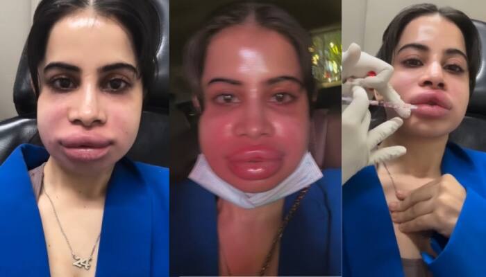 New Delhi: Uorfi Javed left the internet both shocked and concerned. The Traitors fame shared a video on social media, documenting her lip filler dissolving procedure. In the now-viral clip, A doctor is seen injecting her lips Uorfi can be seen groaning in pain her visibly swollen lips and face sparked concern among fans, who flooded the comments wondering what had happened to her.