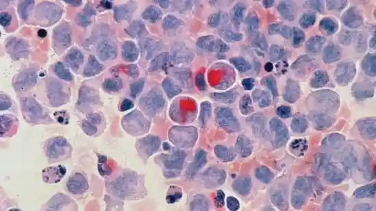 New techniques can predict and prevent lung cancer