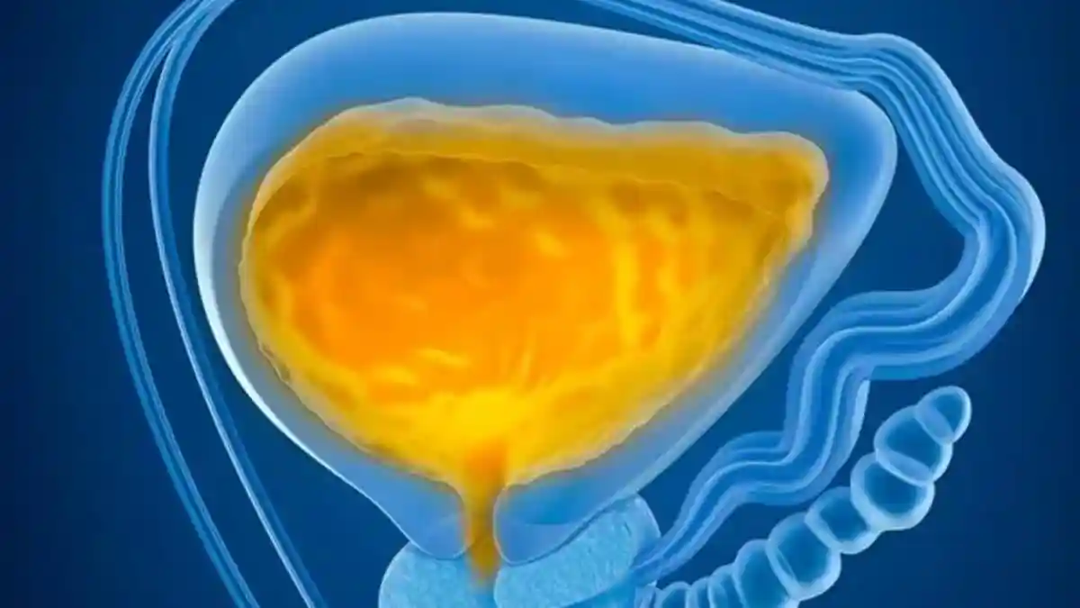 Noticing cloudy urine can be unsettling, but it's not always a sign of something serious. In many cases, it can result from mild dehydration or dietary factors, while in others, it could point to underlying infections or kidney issues. Dr. Gopal Ramdas Tak, Consultant Urologist at Asian Institute of Nephrology and Urology, Hyderabad, explains the common causes of cloudy urine and what you should do in each case.Noticing cloudy urine can be unsettling, but it's not always a sign of something serious. In many cases, it can result from mild dehydration or dietary factors, while in others, it could point to underlying infections or kidney issues.Dr. Gopal Ramdas Tak, Consultant Urologist at Asian Institute of Nephrology and Urology, Hyderabad, explains the common causes of cloudy urine and what you should do in each case.<strong>1. Dehydration</strong>Cause: Not drinking enough water can concentrate the urine, making it appear darker and cloudy.What to do:Increase your fluid intake, especially water.