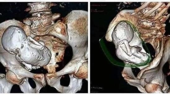 This rare and interesting case highlights the complexities and mysteries of human biology. Here's what you need to know about a calcified fetus. Have you heard of the rare medical phenomenon known as a lithopedion, where a fetus dies in the womb and becomes calcified over time? On June 25, X account Non Aesthetic Things, which has 4.8 million followers on the platform, shared a 'CT scan of a calcified fetus' and said that it had been present for approximately 30 years. Also read | Rare disease: Causes, signs and symptoms, treatment, who should get tested