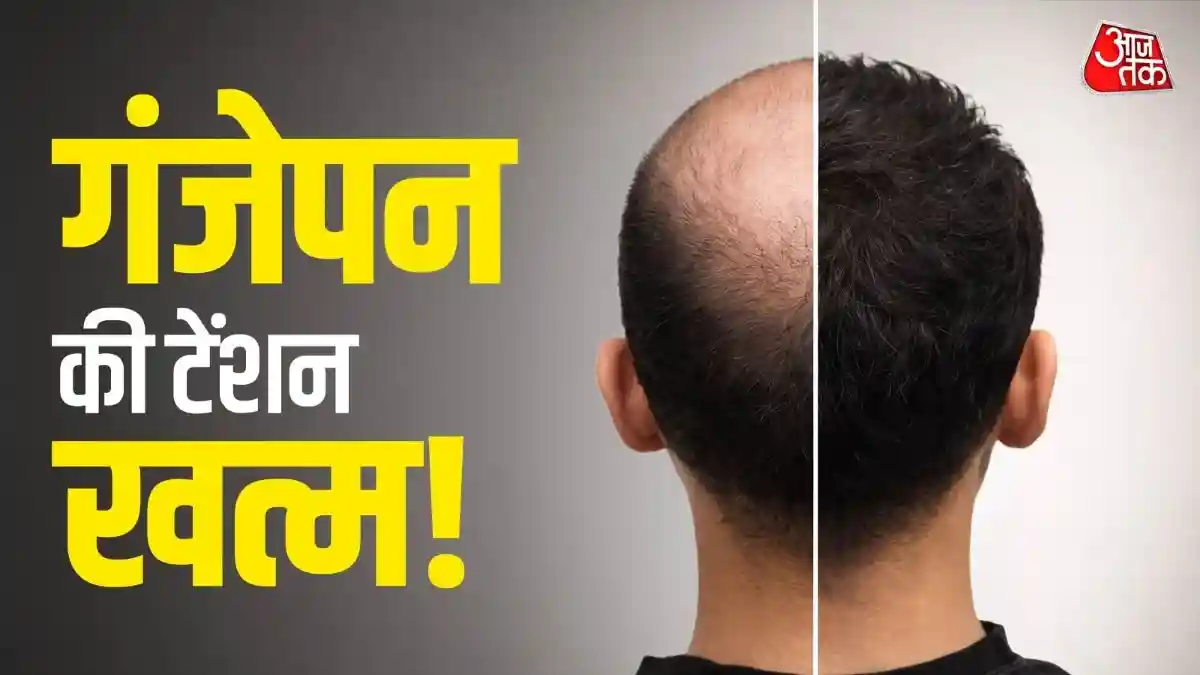 गंजेपन का होगा पक्का इलाज