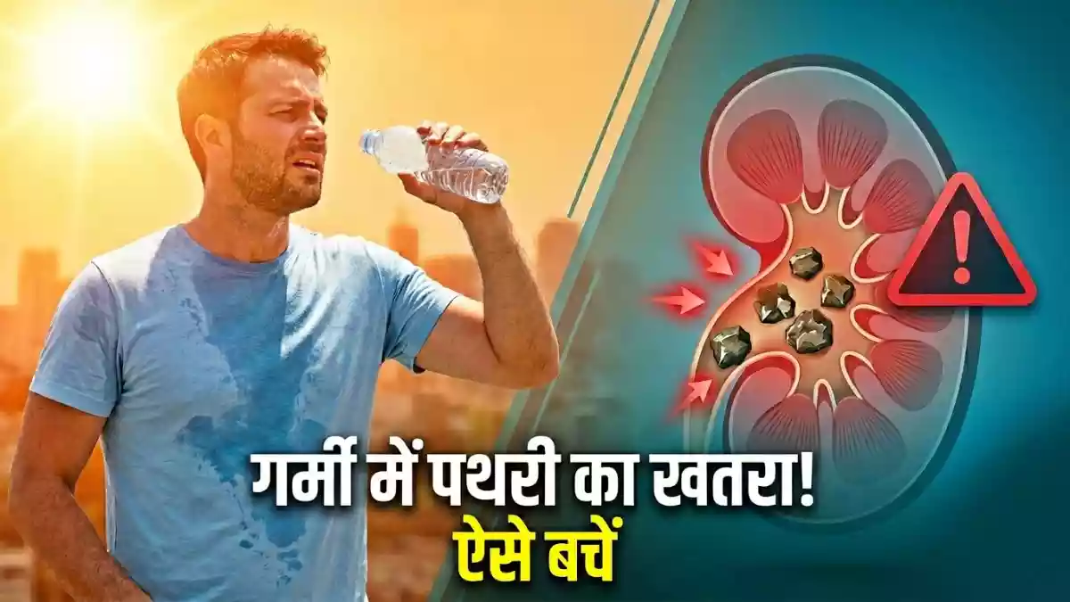 गर्मी में बढ़ रहे पथरी के मामले
