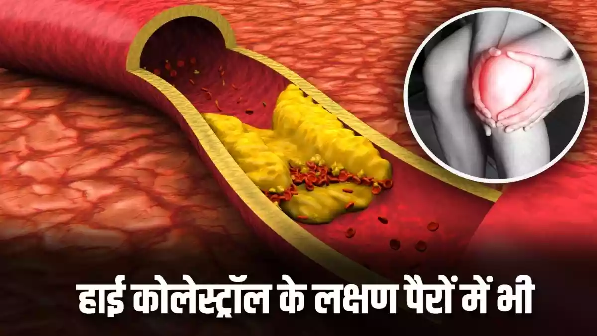 रात में पैरों में दिखते हैं हाई कोलेस्ट्रॉल के ये लक्षण