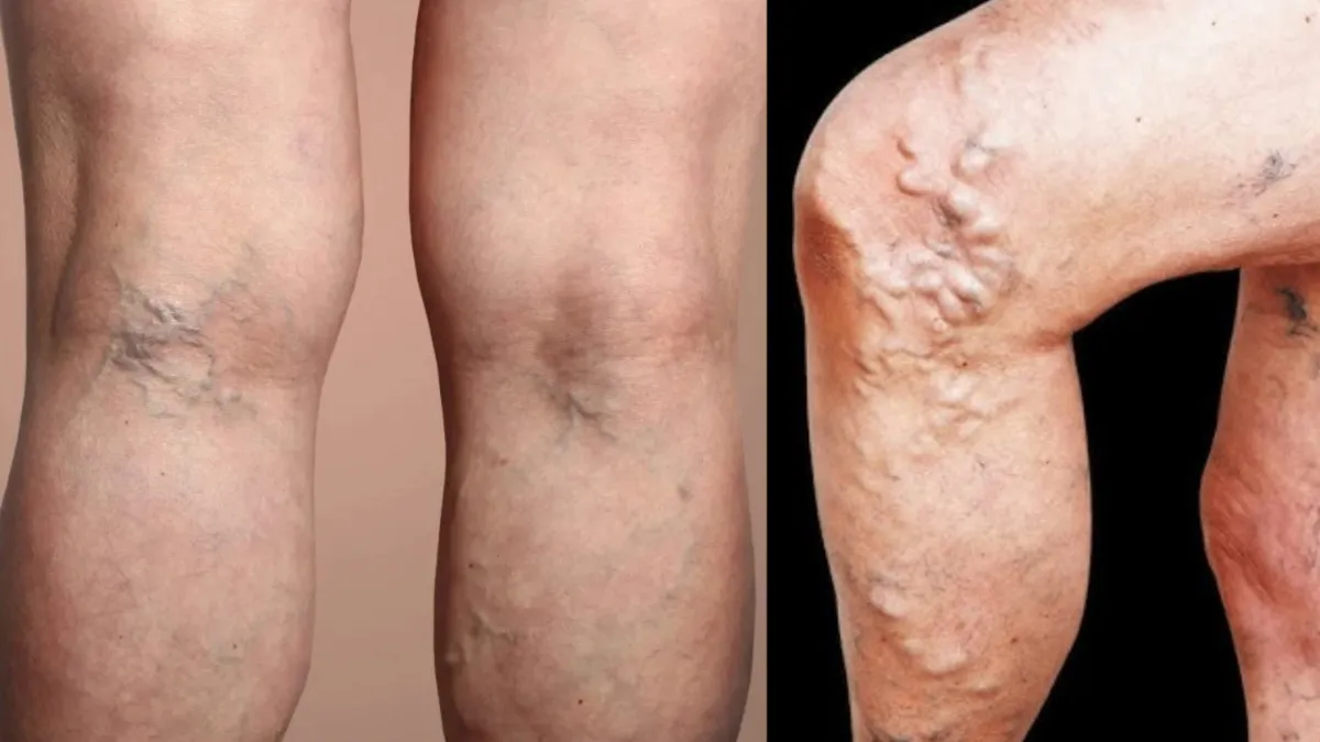 Varicose Veins कितनी खतरनाक