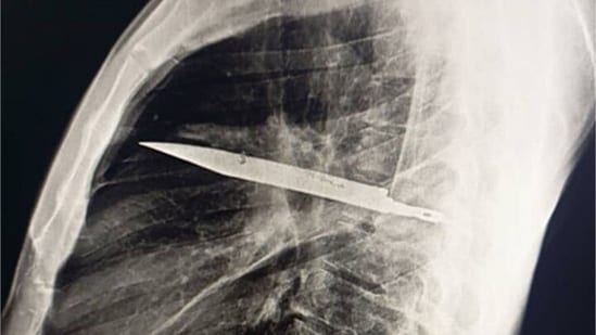 According to a case study published in National Library of Medicine on May 31, 2025, a 44-year-old man, who was 'otherwise healthy', sought medical care after his right nipple began leaking pus – and an X-ray revealed a knife lodged in his chest from an attack eight years earlier. Researchers said doctors were able to remove the knife and highlighted the need for imaging and follow-up treatment. <strong>Also read | </strong><strong>This CT scan belongs to ‘a 73 year old woman in whom doctors discovered a 30 year old calcified fetus' aka stone baby</strong>
