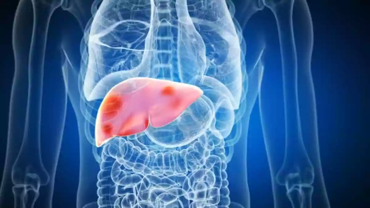 Alcohol-related liver disease continues to be a major concern in today’s scenario. The rising trend of binge drinking, along with early exposure to alcohol