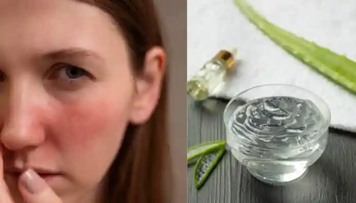 Aloe Vera is widely used for skincare, but it can cause side effects like irritation, rashes, and allergic reactions in some people. Those with sensitive skin, eczema, or plant allergies should use it cautiously. Overuse may lead to dryness or sun sensitivity. Knowing the risks ensures safe and effective use of Aloe Vera on skin.