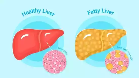 An increased build-up of fat in the liver is known as fatty liver disease. There are two types: one is caused by heavy drinking (alcoholic fatty liver disease), and the other is nonalcoholic fatty liver disease (NAFLD), which is seen in people who drink little or no alcohol.An increased build-up of fat in the liver is known as fatty liver disease. There are two types: one is caused by heavy drinking (alcoholic fatty liver disease), and the other is nonalcoholic fatty liver disease (NAFLD), which is seen in people who drink little or no alcohol.Also Read | Cardiologist reveals patient thought his low heart rate was just ‘good fitness'; warns why it is dangerousQuitting alcohol, eating whole foods, avoiding ultra-processed foods, and limiting sugar consumption are some ways you can minimise the risk of fatty liver disease. However, did you know that consuming certain drinks can also be beneficial?In an Instagram post shared on September 29, Dr Saurabh Sethi, a gastroenterologist and liver specialist trained at AIIMS, Harvard and Stanford Universities, recommended three specific drinks for patients dealing with fatty liver disease, emphasising their potential benefits.