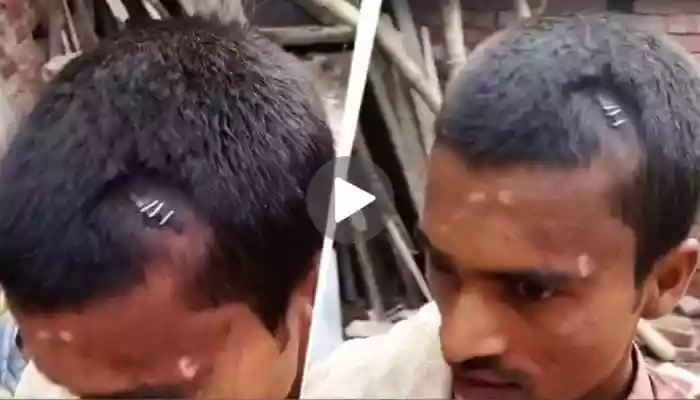 Bihar quack 'stapling' bleeding brain injury with stationery pins