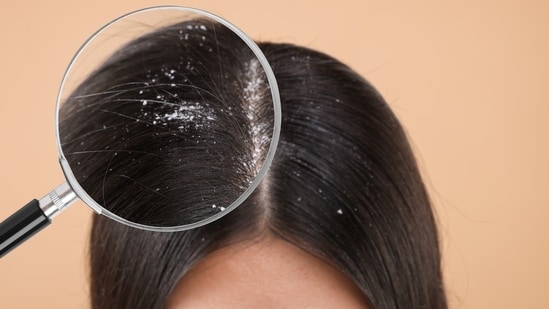 Both dandruff and fungal infections cause flaking, but their causes and treatments differ vastly. That’s why it’s important to tell the apart. Dandruff is a common scalp woe, but surprisingly, not every flake is what it seems. Many may dismiss dandruff as just a haircare misstep, but it may also point to a more serious scalp issue, like a fungal infection. It's easy to mix them up, but by understanding the key differences, one can get the right diagnosis and treatment before the problem worsens. In an interview with HT Lifestyle, Dr BL Jangid, Dermatologist, Hair Transplant Surgeon at SkinQure Clinic, New Delhi, outlined the key differences between dandruff and fungal scalp infections.