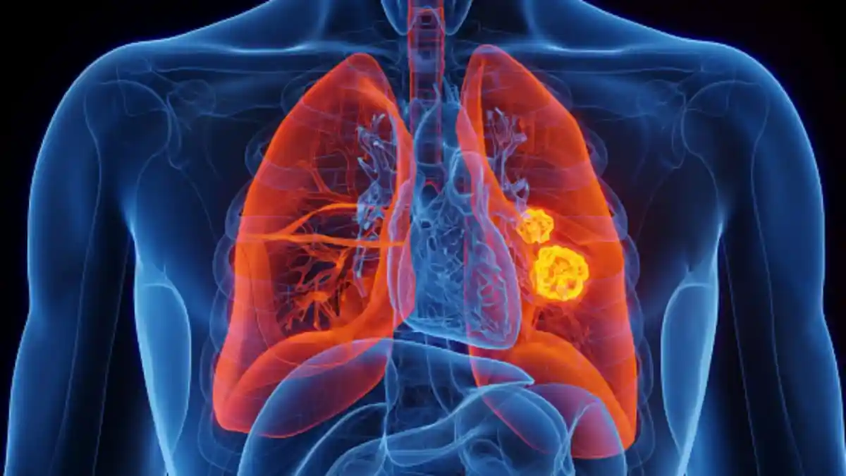 Lung cancer remains one of the world's most challenging and complex diseases, often developing silently and progressing before symptoms become noticeable