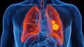 Lung cancer remains one of the world's most challenging and complex diseases, often developing silently and progressing before symptoms become noticeable