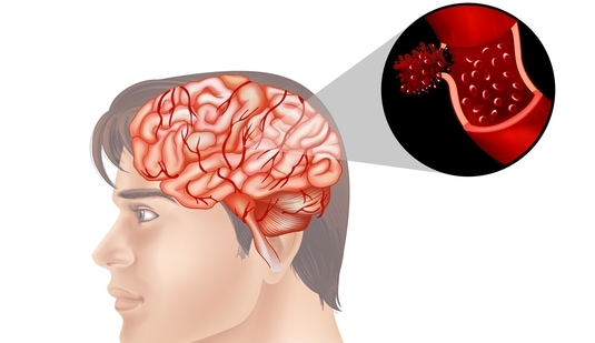 Cases of the fatal brain-eating amoeba, first detected in Kerala in 2024, continue to rise as yet another person, a 17-year-old boy from Thiruvananthapuram, has been diagnosed with the infection. According to Integrated Disease Surveillance Programme data on September 14, the total number of amoebic meningoencephalitis cases in the state has reached 67, with 18 deaths.