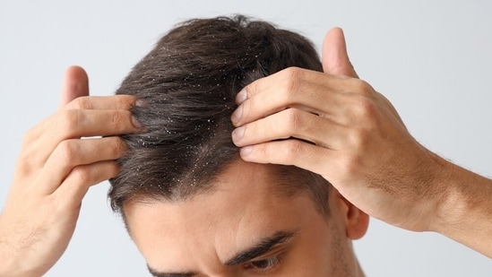Dandruff can be very stubborn. The frustrating white flakes show up on your scalp and appear on your shoulders like tiny snowflakes. But if there's something more stubborn than regular dandruff, it's sticky dandruff (true to its name.) ALSO READ: <strong>Is stress one of the main triggers of hairfall? 8 tips to protect your hair</strong>