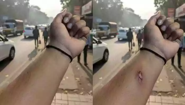 In a shocking incident highlighting AI risks, a worker generated a fake wound image to fool HR, raising alarms over deepfake abuse across industries