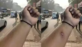 In a shocking incident highlighting AI risks, a worker generated a fake wound image to fool HR, raising alarms over deepfake abuse across industries