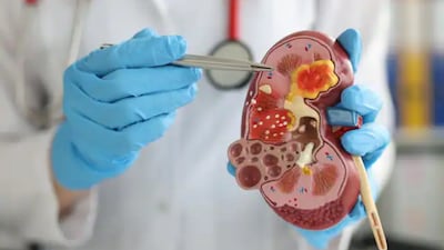 End-Stage Renal Disease (ESRD) the final and most critical stage of chronic kidney disease (CKD) is emerging as a pressing public health challenge in India. At this stage, the kidneys lose nearly all function, making life-sustaining treatments like dialysis or kidney transplantation essential.