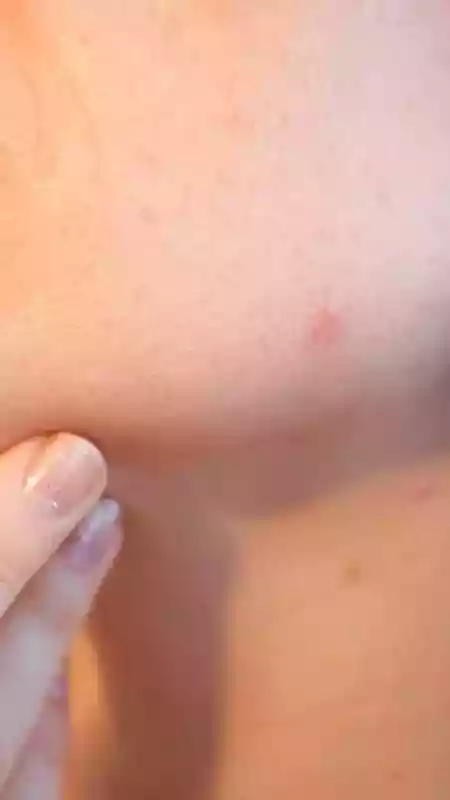 Editorial independence is core to our work. Some links may earn us a commission, without influencing our opinions.<h4>Is your acne telling a deeper