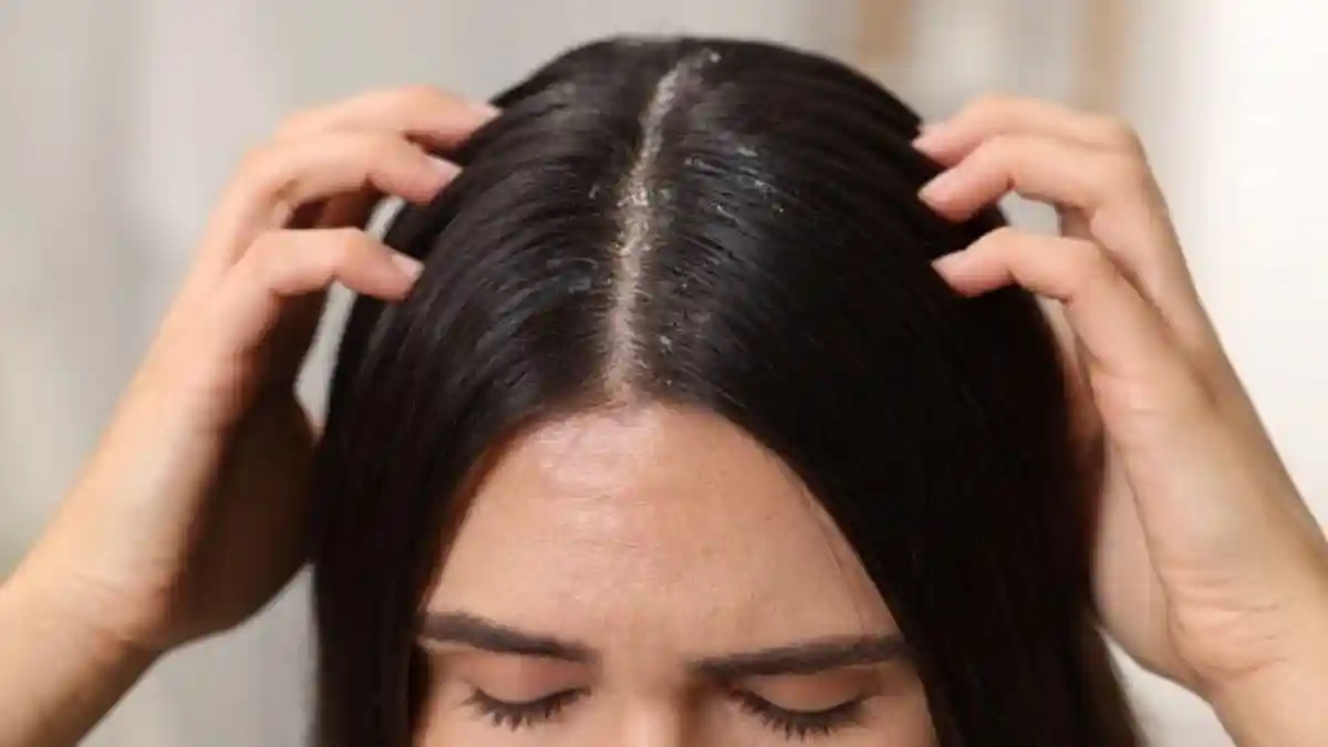 Winter can be harsh on your skin and your scalp is no exception. As temperatures drop and humidity levels fall, the scalp's natural oil balance gets disrupted