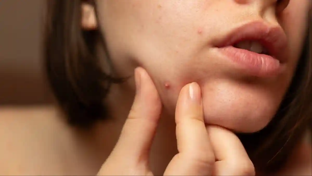 For many women, acne that won't clear, sudden hair thinning, and unwanted facial hair feel like purely cosmetic problems. But these visible signs are often the body's way of signalling deeper issues. Polycystic Ovary Syndrome (PCOS) affects millions of women globally and manifests not only in the ovaries but also through skin and hair changes. Recognising these symptoms early can prevent long-term complications and improve overall well-being.