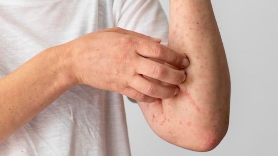 From bathing daily to staying hydrated, the best way to prevent fungal infections is by maintaining good hygiene. Here's everything you need to know. As heat and humidity rise during the summer, fungal infections see a sharp increase. The moist environment created by sweat on the skin provides an ideal breeding ground for fungi. In an interview with HT Lifestyle, Dr Gunjan Verma, consultant, dermatology, Manipal Hospital Dwarka, New Delhi said, “Fungal infections are painful, uncomfortable, contagious, and common during the summer. The best way to prevent them is through good hygiene, timely medical attention, and daily cleanliness habits.” Also read | ‘Flesh-eating’ fungus: Fatal infection on the rise but this new antibody treatment could change everything, says study