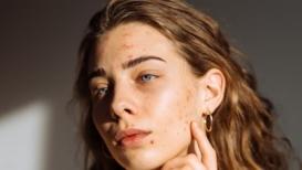<h4>Fungal vs bacterial acne: Dermatologist explains how to identify your monsoon breakout</h4> Published on: Aug 26, 2026