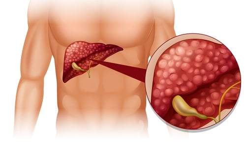 Hardened deposits of bile found in your gallbladder are known as gallbladder stones, also known as gallstones or cholelithiasis. They're quite common, especially in females. Per the Clinical Gastroenterology and Hepatology, the prevalence of gallstones is higher in females vs males (7.6 vs 5.4 percent). Globally, 6 percent of the population has gallstones.