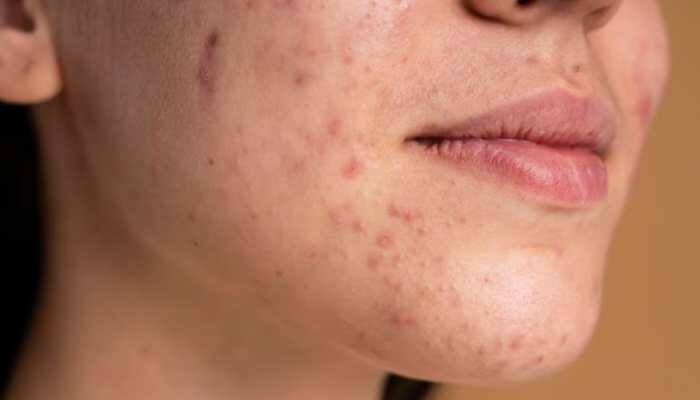 Having a face with an acne breakout is an embarrassing situation, isn't it? According to a study published in the International Journal of Pharmacy and Pharmaceutical Sciences in 2022, an estimated 72.3% of adolescents and 27% of adults experience acne. Acne can be stubborn and pop up on your face when you least expect it.