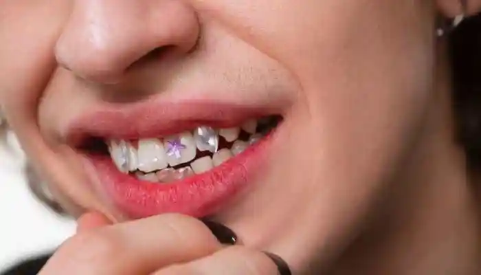 In a bizarre trend, Chinese youth are getting motivational phrases engraved on dental caps. While some call it “cute,” experts warn of damage. In China, a quirky new fad is catching attention young people are getting motivational phrases like “get rich” and “ensure success” engraved on their dental caps.