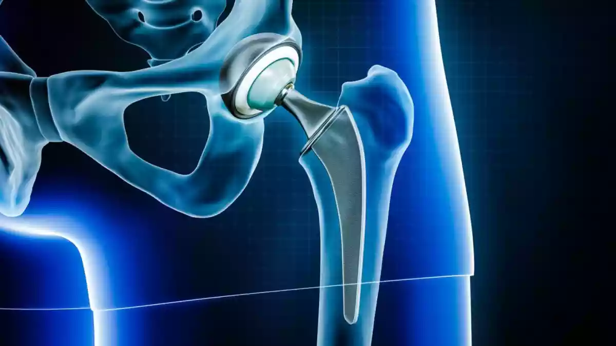 Is Hip Replacement As Risky As It Sounds