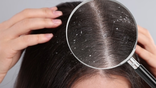 Know the reasons behind why your scalp is acting up during the monsoon and what you can do about it. This expert-backed guide covers all essentials. Monsoon season brings cool air and cosy weather, but it also quietly invites trouble with a host of skin and haircare issues, particularly increasing dandruff. Even when your haircare routine seems in check and going all fine, the sudden onslaught of humidity, sweat, and rain during monsoon may throw your scalp health completely haywire. You need to be well-informed about seasonal dandruff to be able to tackle it.