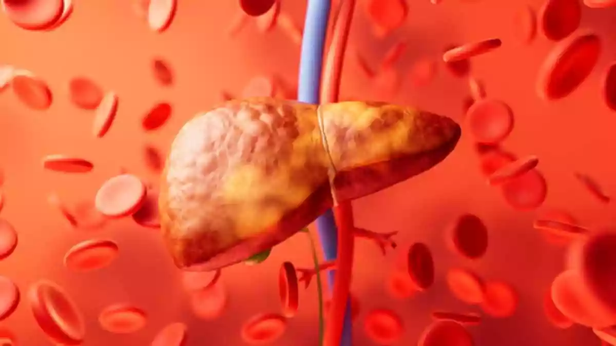 For many years, liver disease has been closely associated with alcohol consumption. However, this is no longer the full picture. Today