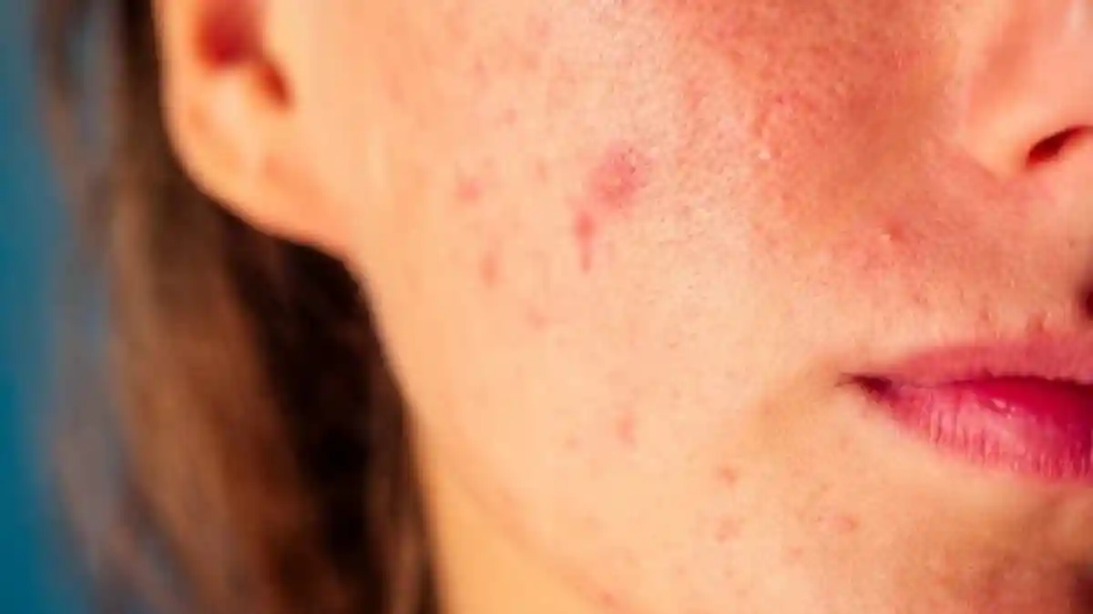 Most people think of acne and breakouts as surface-level skin issues, but dermatologists stress that what happens inside the body often decides how our skin looks. Internal inflammation, hormonal shifts, and body weight are increasingly being linked to acne, rashes, and other chronic skin concerns. We talked to experts to find out how systemic inflammation spills over to the skin, and what you can do about it.