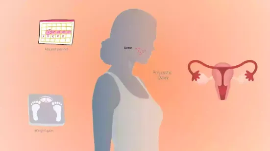 Polycystic Ovarian Disease (PCOD) is one of the most common hormonal disorders affecting women during their reproductive years, usually between the ages of 12