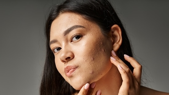 Sometimes the acne breakout may be the body's way of asking for help. Hormonal acne is one type that shows health problems beyond just skin issues. Breakouts on the jaw and chin may indicate a health issue. Acne is not just a surface-level, skin-deep issue. It’s not always a case of sleeping with makeup on or using the wrong moisturiser. Acne can also signify hormonal imbalances. Understanding a more holistic approach to acne treatment is key to addressing it at the root. 