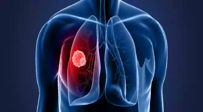 Lung cancer is increasingly affecting non-smokers in India due to pollution, environmental exposure, genetic factors. Experts explain why early screening and