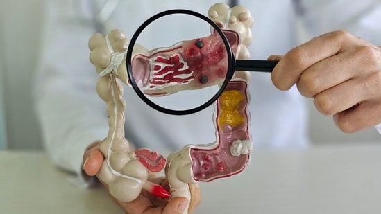 The number of cases of colon cancer (CRC), also known as colorectal cancer, among young people is on the rise. This alarming situation has many appearing increasingly at doctors' offices, complaining of blood in their stool, abdominal trouble or unexplained weight loss.