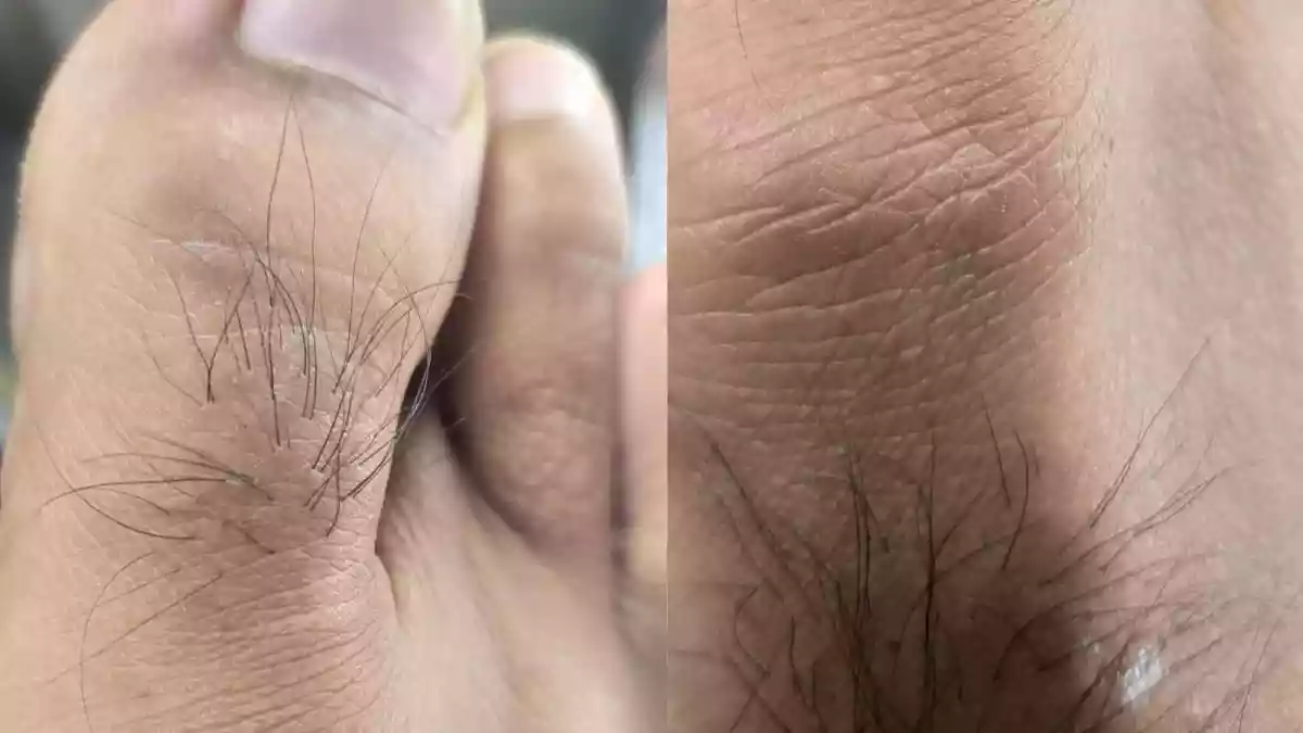 Often ignored, the hair on your toes could be signalling something very important about your body's cardiovascular health. According to Dr Shraddhey Katiyar