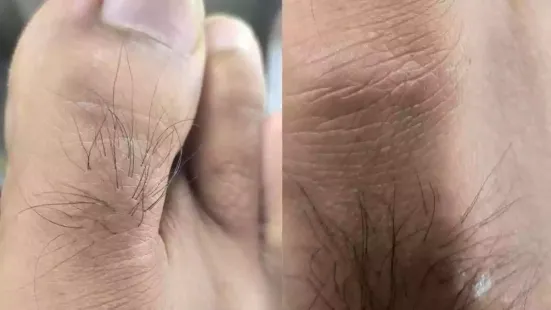 Often ignored, the hair on your toes could be signalling something very important about your body's cardiovascular health. According to Dr Shraddhey Katiyar